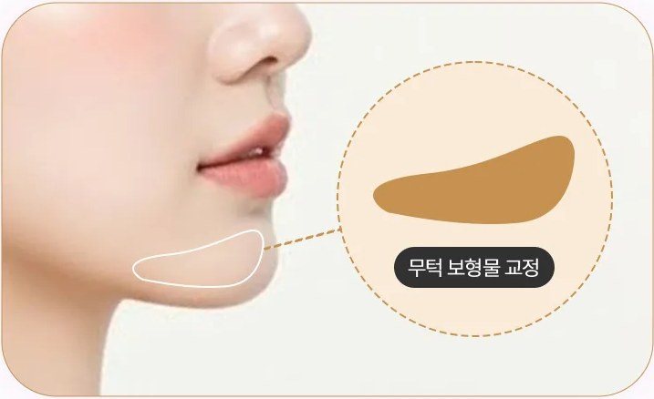턱 끝 무턱 보형물 교정 시술 일러스트 및 설명