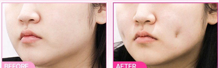 측면 보조개 시술 전후 비교 사진