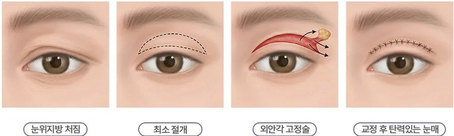 눈위지방 처짐 교정 수술 과정 일러스트