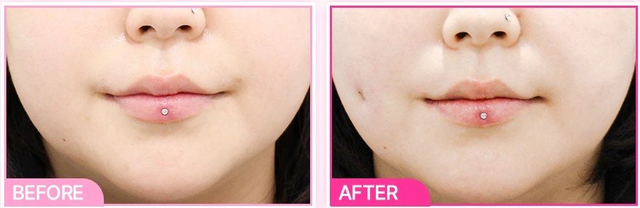 보조개 시술 전후 비교 사진