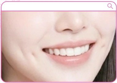 입꼬리 보조개 시술 예시