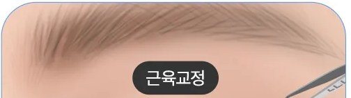 근육교정 수술 과정을 보여주는 눈 일러스트