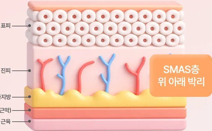표피, 진피, 피하지방, SAMS(근막), 근육 및 SMAS층 위 아래 박리를 나타낸 피부 구조 일러스트