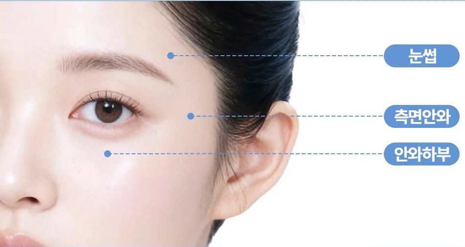아이슈링크 시술 부위(눈썹, 측면안와, 안와하부)를 안내하는 여성 얼굴 측면 사진