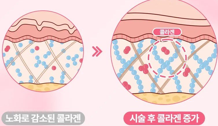 노화로 감소된 콜라겐과 시술 후 콜라겐 증가를 비교한 피부 단면 일러스트