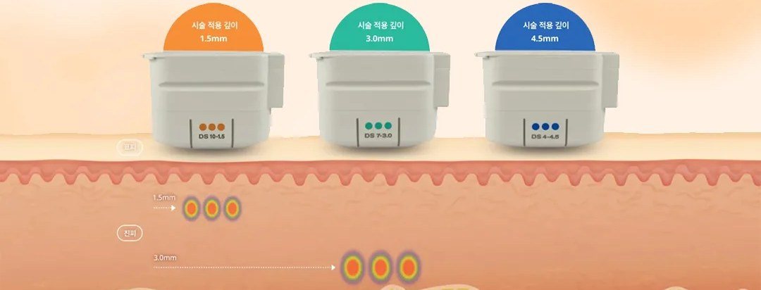 울쎄라 팁 종류별(1.5mm, 3.0mm, 4.5mm) 피부 침투 깊이 안내 도표