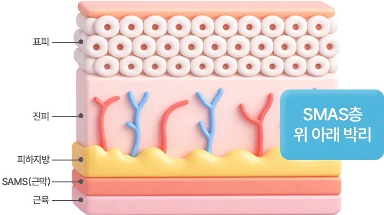 표피, 진피, 피하지방, SMAS 근막, 근육 등 피부 구조와 SMAS층 박리 안내 일러스트