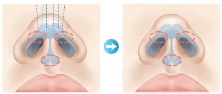 연골이 벌어진 경우 수술 방법 일러스트