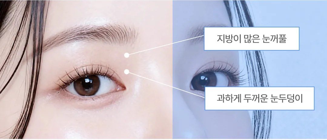 눈꺼풀 지방 및 눈두덩이 문제점을 보여주는 여성의 눈 클로즈업 사진