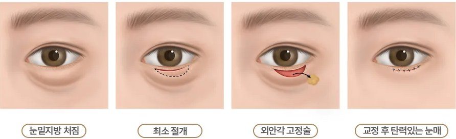 눈밑 교정 수술 과정 일러스트(눈밑지방 처짐, 최소 절개, 외안각 고정술, 교정 후 탄력있는 눈매)