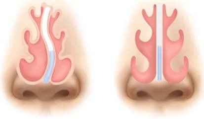 코뼈가 휘어진 경우 교정 일러스트