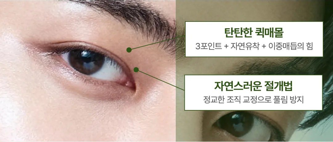 눈 클로즈업 사진 및 수술 포인트 안내